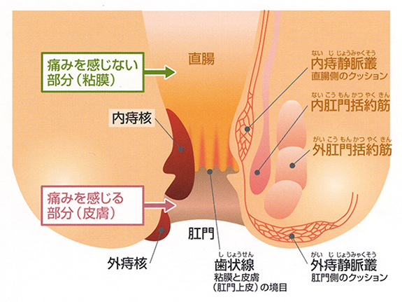 痔核